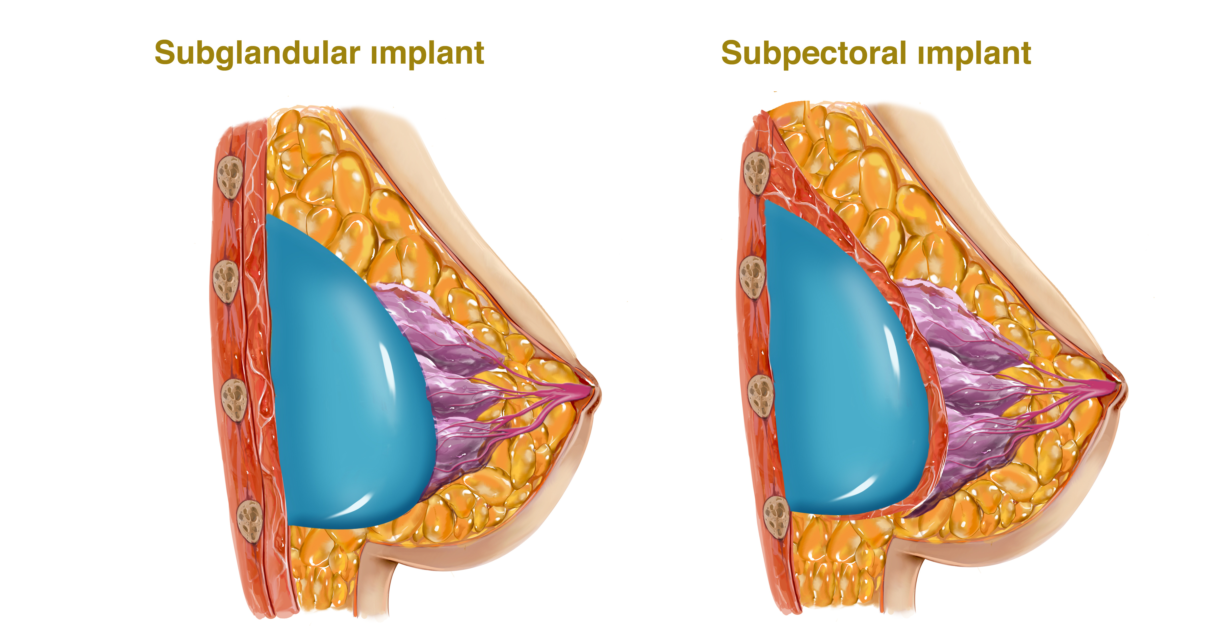 Brust-OP Köln, Brustaugmentation mit Silikonimplantat