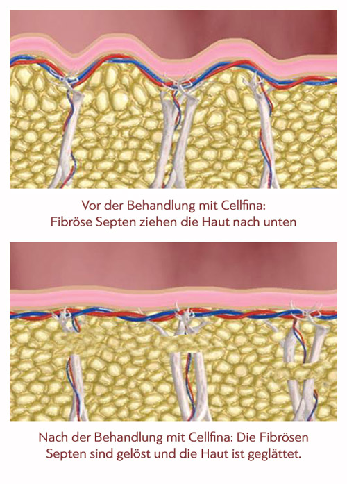 Cellulite an der Ursache bekämpfen mit Cellfina