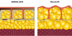 Wie entsteht Cellulite?