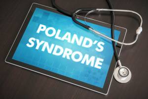 Poland Syndrom behandeln in Köln